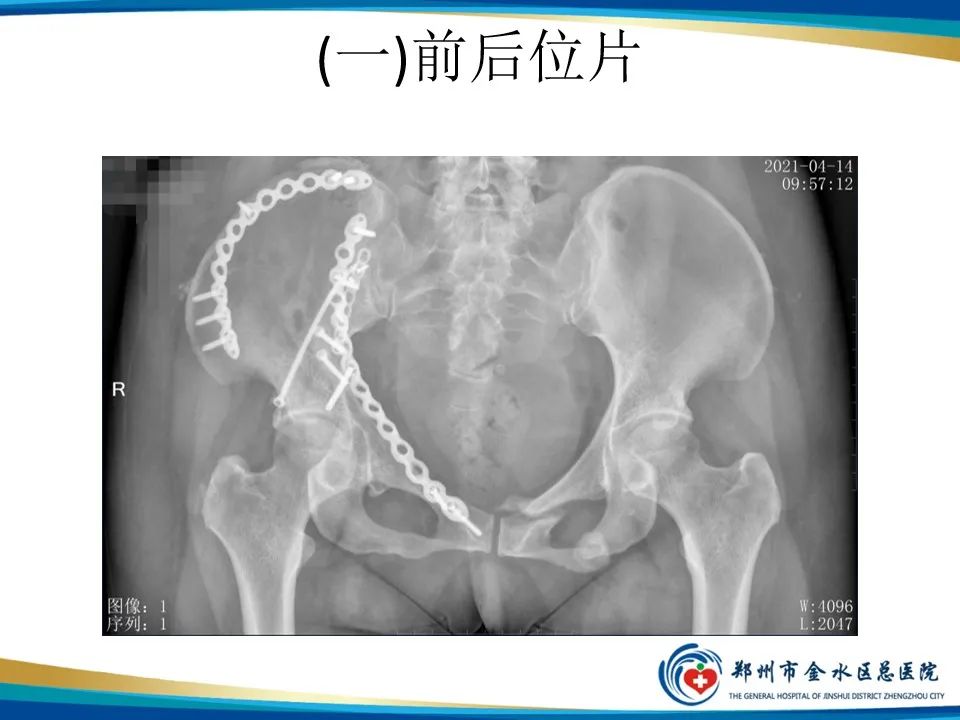 影像PPT - 【PPT】骨盆拍片技术与临床意义-8