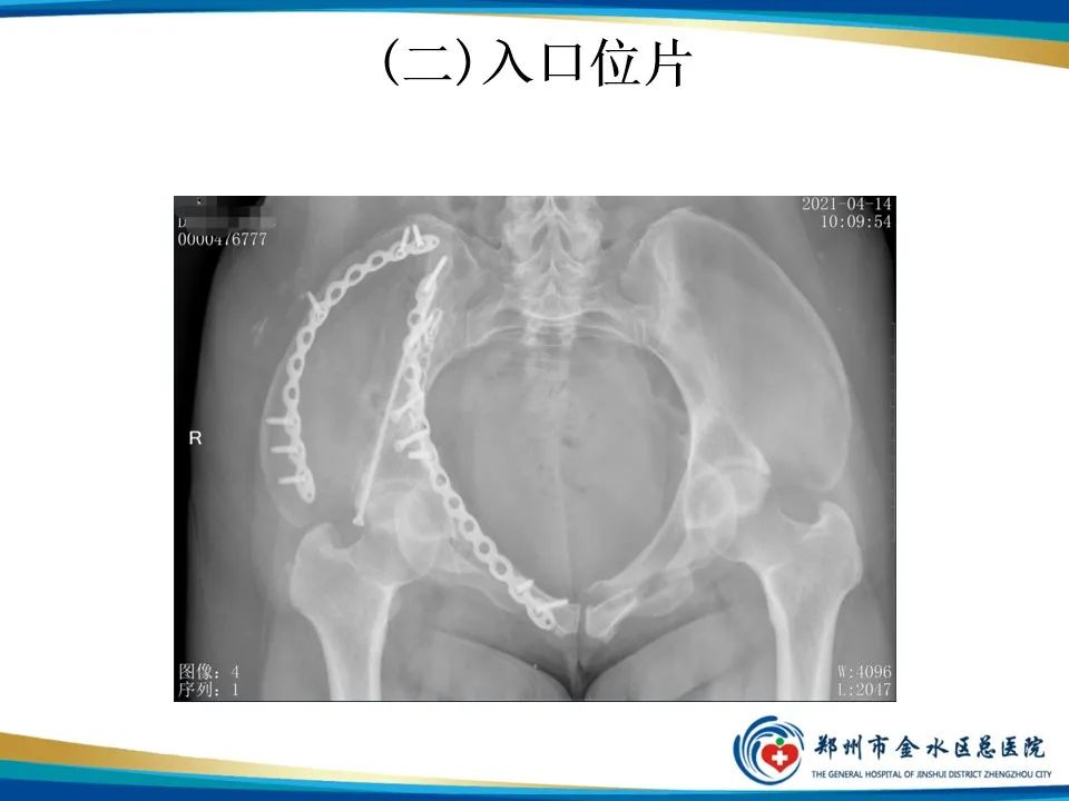 影像PPT - 【PPT】骨盆拍片技术与临床意义-12