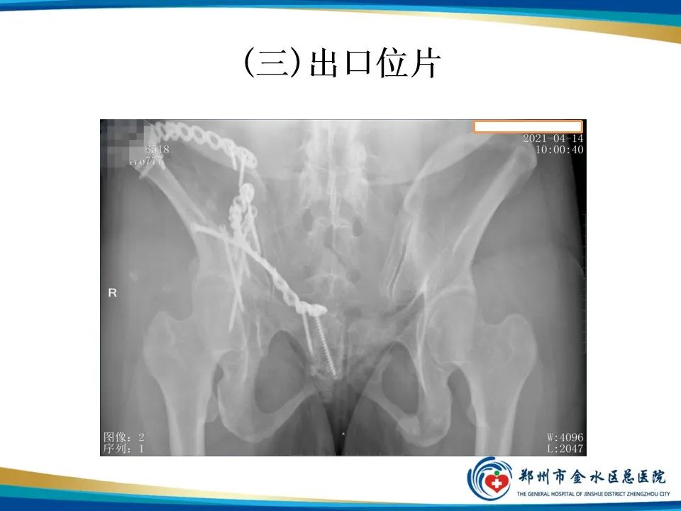 影像PPT - 【PPT】骨盆拍片技术与临床意义-16