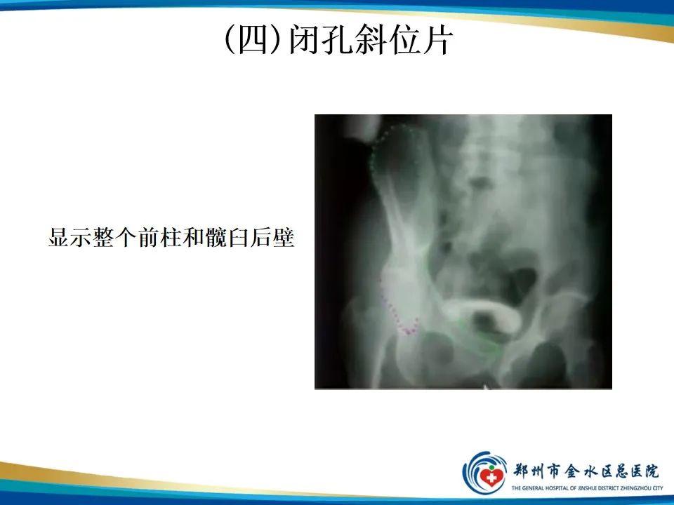 影像PPT - 【PPT】骨盆拍片技术与临床意义-18