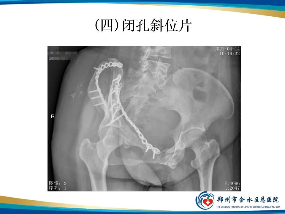 影像PPT - 【PPT】骨盆拍片技术与临床意义-20