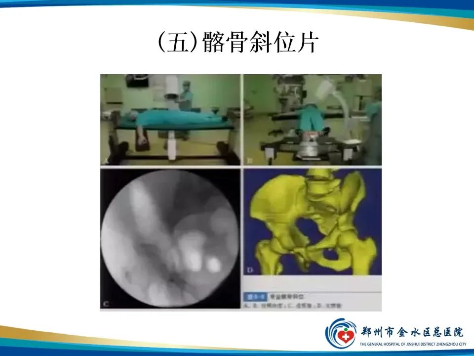 影像PPT - 【PPT】骨盆拍片技术与临床意义-23
