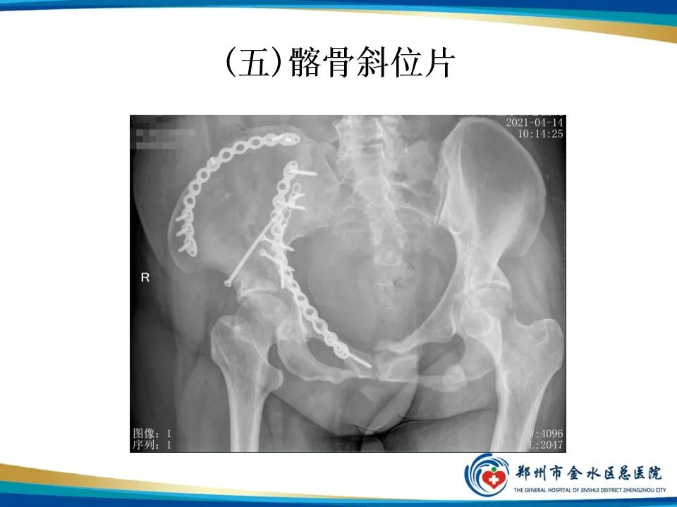 影像PPT - 【PPT】骨盆拍片技术与临床意义-24