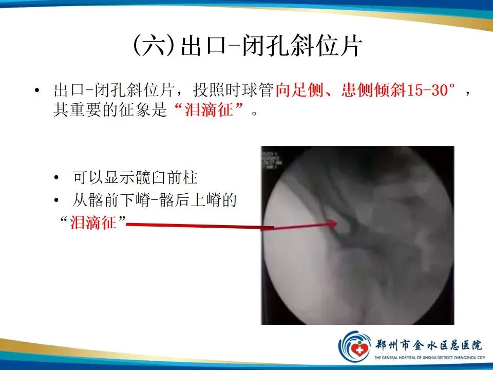 影像PPT - 【PPT】骨盆拍片技术与临床意义-25
