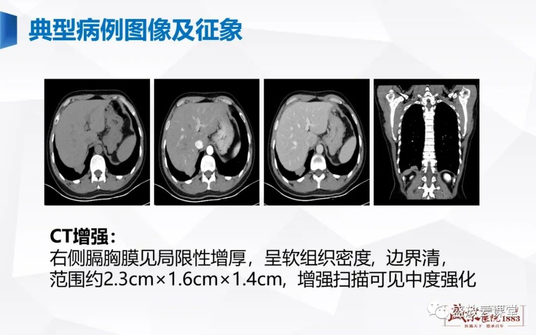 影像PPT - 【PPT】胸膜病变-4
