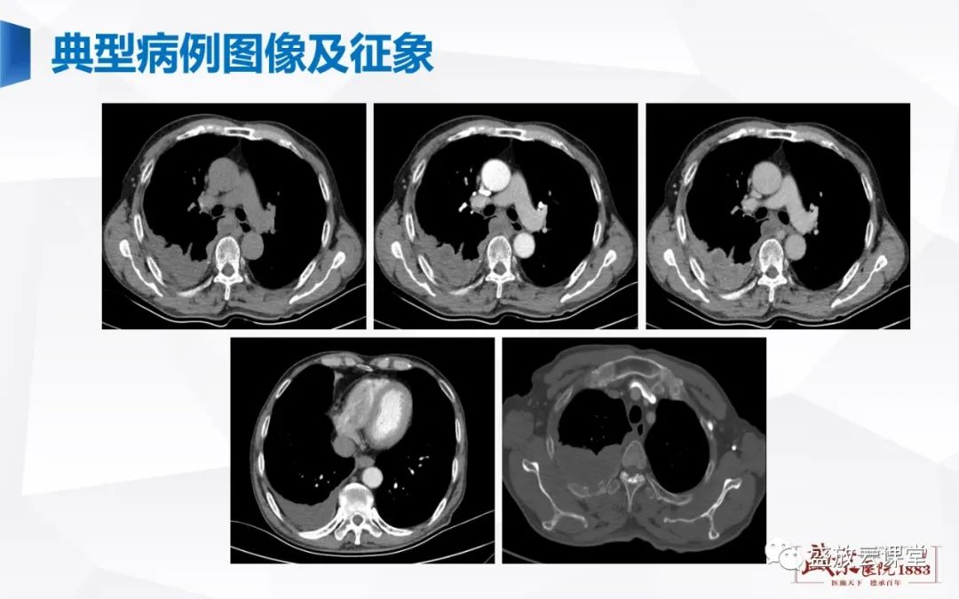影像PPT - 【PPT】胸膜病变-8