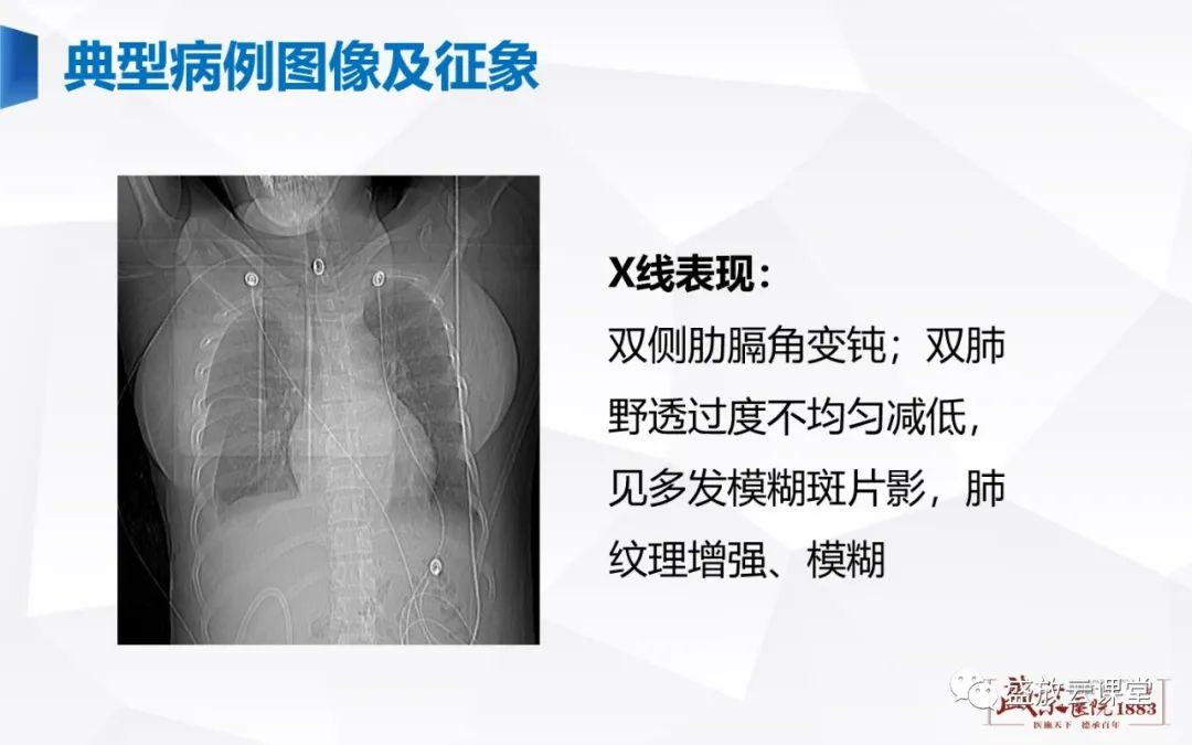 影像PPT - 【PPT】胸膜病变-17