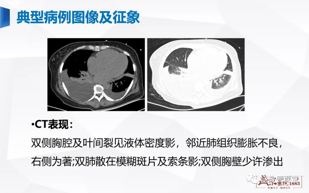 影像PPT - 【PPT】胸膜病变-18