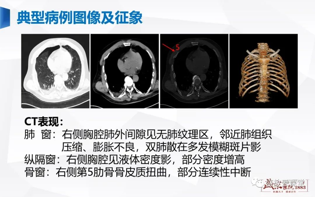 影像PPT - 【PPT】胸膜病变-23