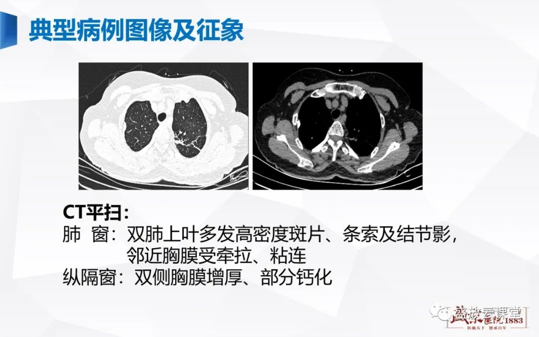 影像PPT - 【PPT】胸膜病变-29