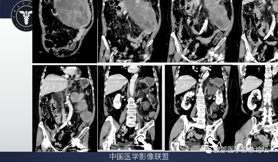 影像PPT - 【病例】腹膜后去分化脂肪肉瘤 VS 高分化脂肪肉瘤-5