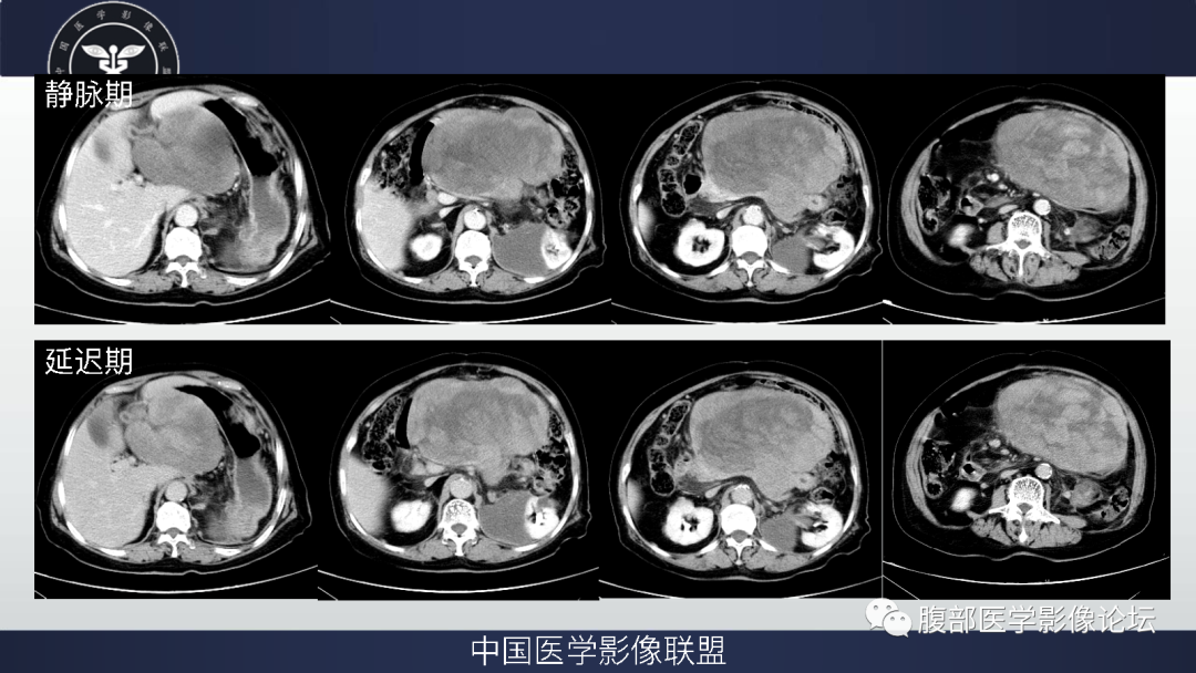 影像PPT - 【病例】腹膜后去分化脂肪肉瘤 VS 高分化脂肪肉瘤-4