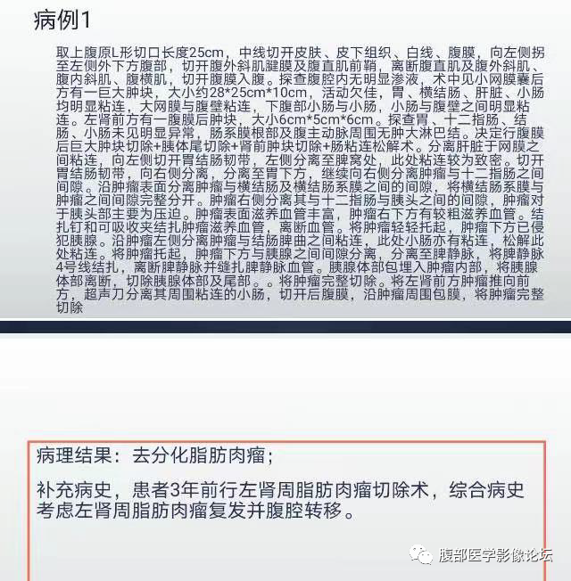 影像PPT - 【病例】腹膜后去分化脂肪肉瘤 VS 高分化脂肪肉瘤-6