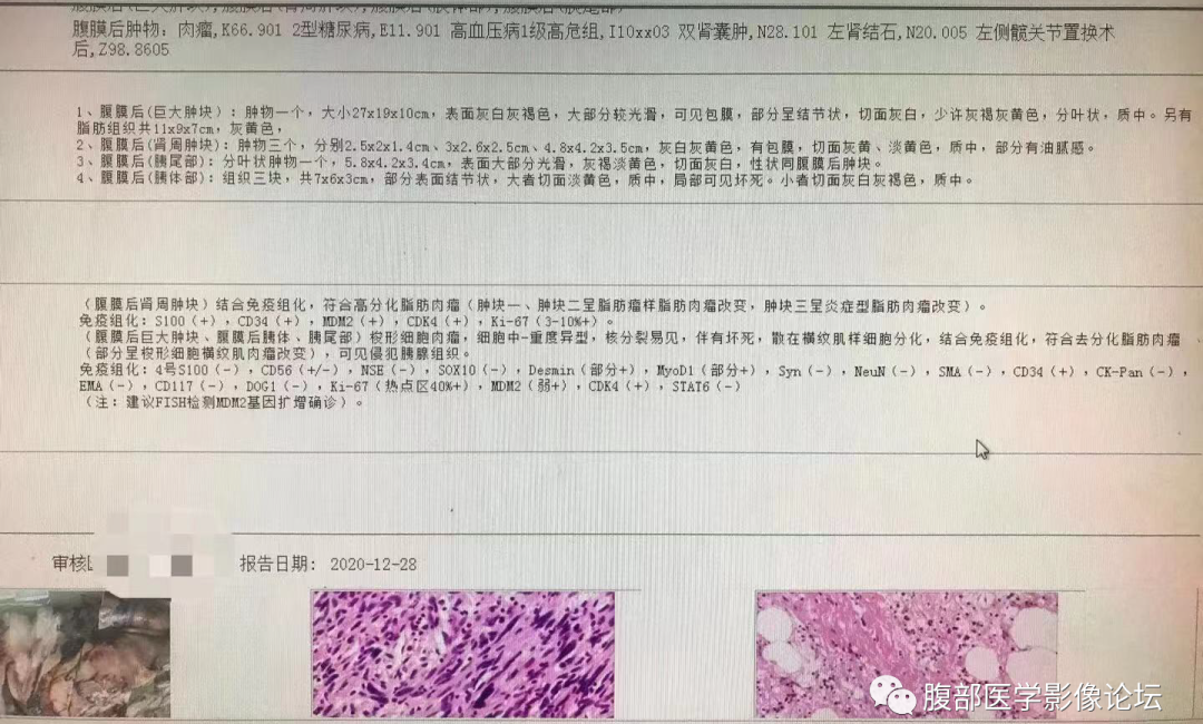 影像PPT - 【病例】腹膜后去分化脂肪肉瘤 VS 高分化脂肪肉瘤-11