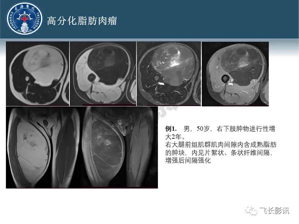 影像PPT - 【病例】腹膜后去分化脂肪肉瘤 VS 高分化脂肪肉瘤-19