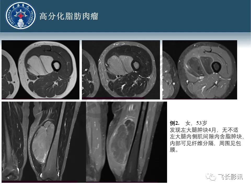 影像PPT - 【病例】腹膜后去分化脂肪肉瘤 VS 高分化脂肪肉瘤-20
