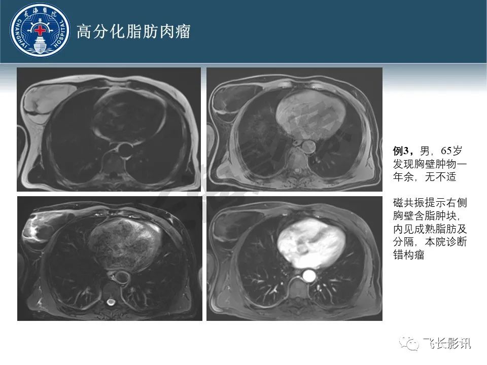 影像PPT - 【病例】腹膜后去分化脂肪肉瘤 VS 高分化脂肪肉瘤-21