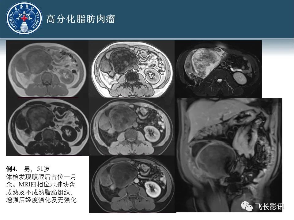 影像PPT - 【病例】腹膜后去分化脂肪肉瘤 VS 高分化脂肪肉瘤-22