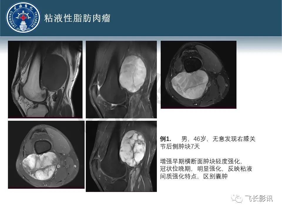 影像PPT - 【病例】腹膜后去分化脂肪肉瘤 VS 高分化脂肪肉瘤-25