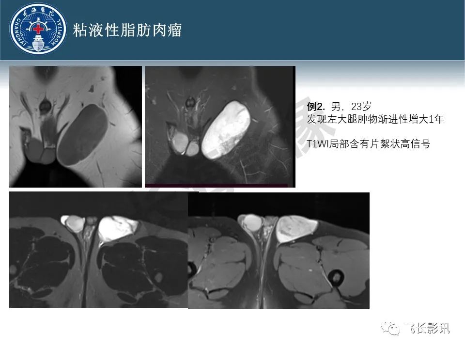 影像PPT - 【病例】腹膜后去分化脂肪肉瘤 VS 高分化脂肪肉瘤-26