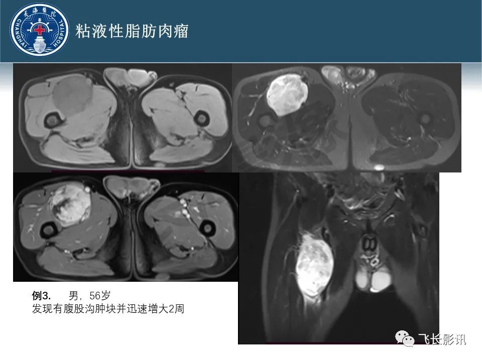 影像PPT - 【病例】腹膜后去分化脂肪肉瘤 VS 高分化脂肪肉瘤-27