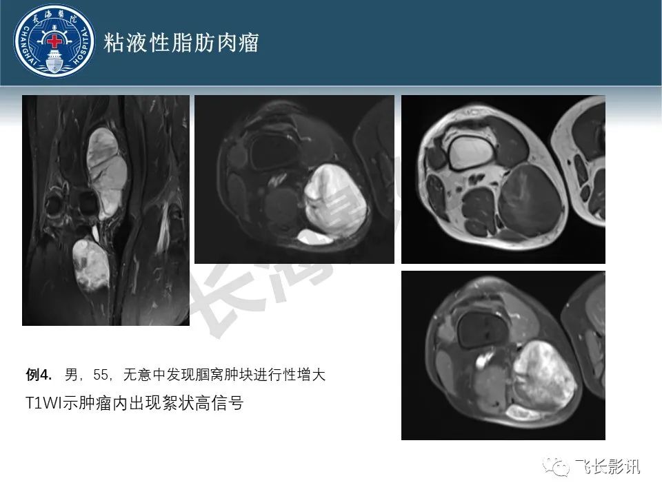 影像PPT - 【病例】腹膜后去分化脂肪肉瘤 VS 高分化脂肪肉瘤-28