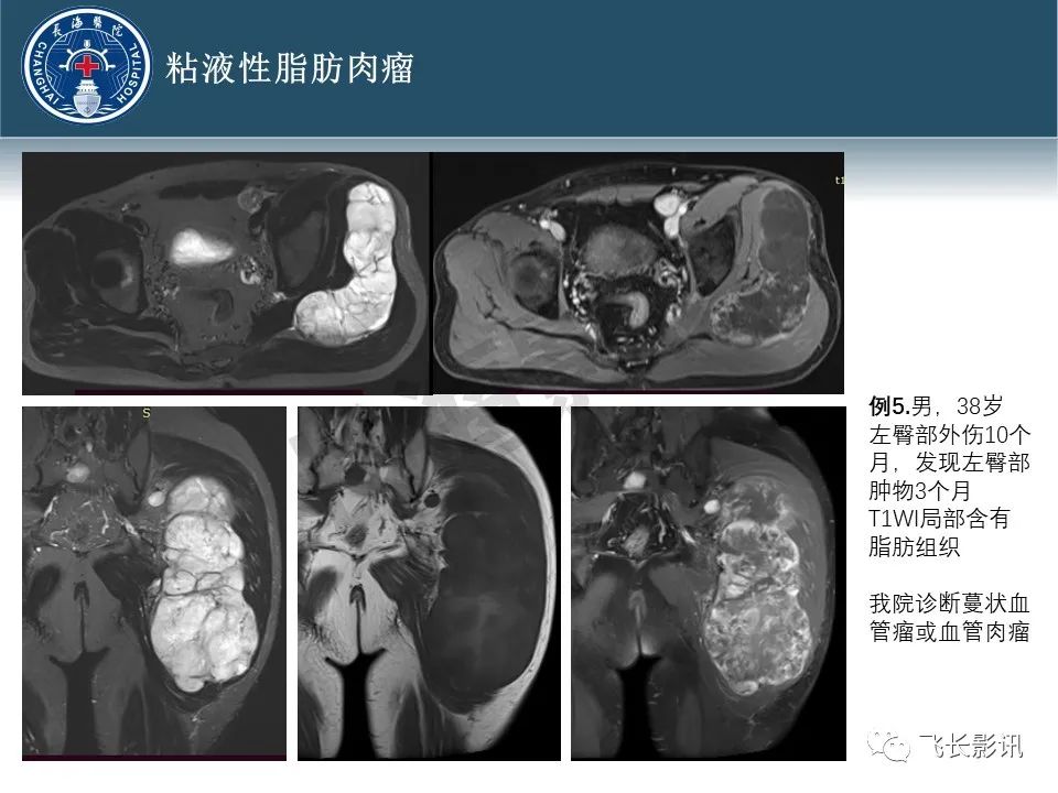 影像PPT - 【病例】腹膜后去分化脂肪肉瘤 VS 高分化脂肪肉瘤-29