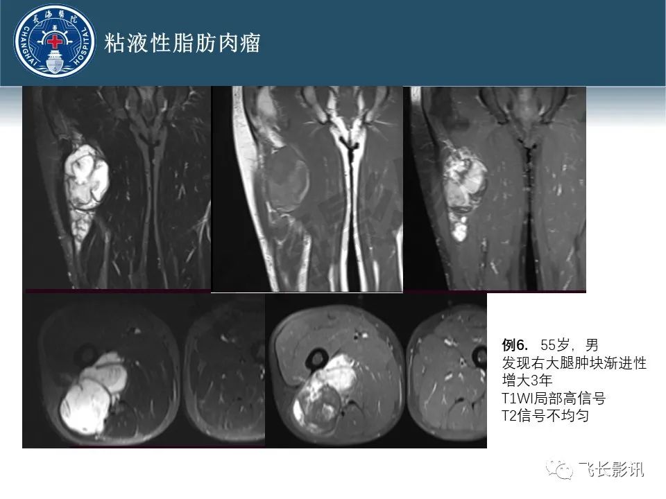 影像PPT - 【病例】腹膜后去分化脂肪肉瘤 VS 高分化脂肪肉瘤-30