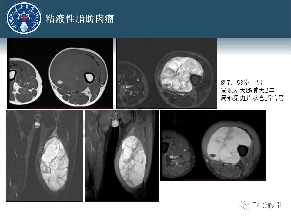 影像PPT - 【病例】腹膜后去分化脂肪肉瘤 VS 高分化脂肪肉瘤-31