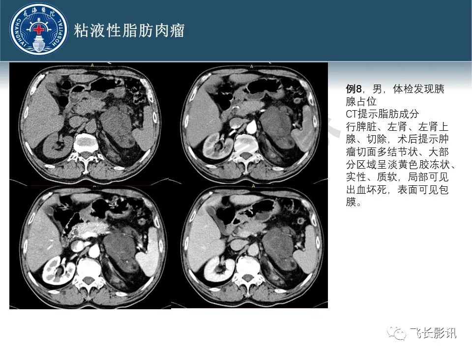 影像PPT - 【病例】腹膜后去分化脂肪肉瘤 VS 高分化脂肪肉瘤-32