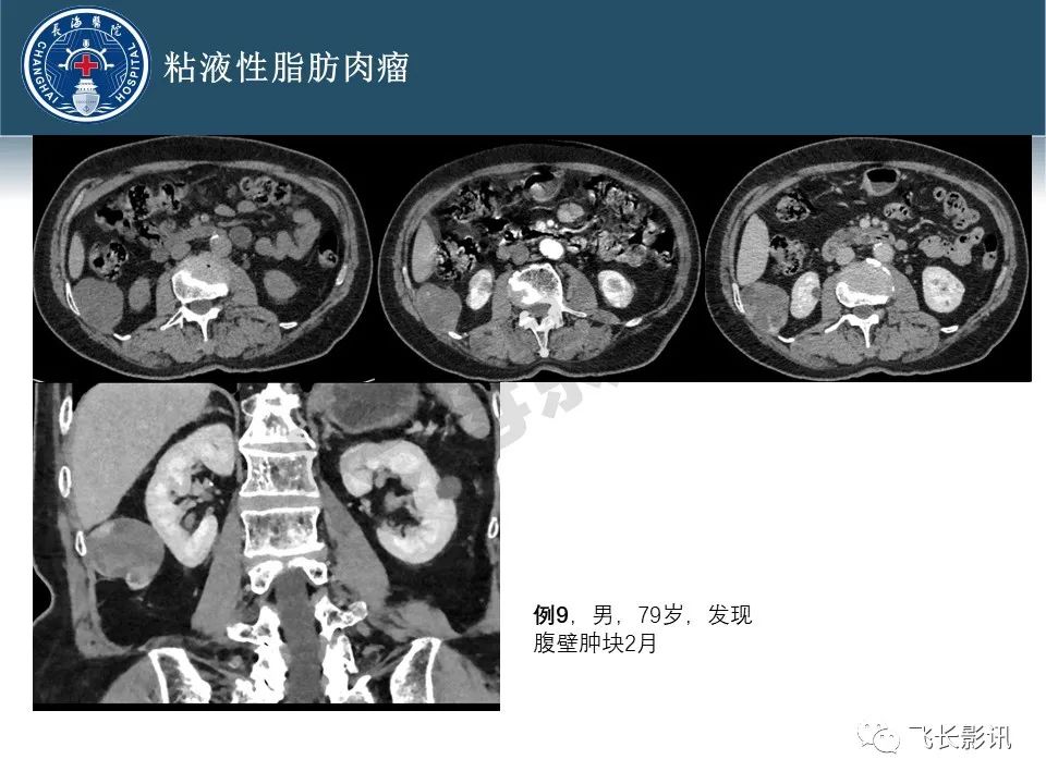 影像PPT - 【病例】腹膜后去分化脂肪肉瘤 VS 高分化脂肪肉瘤-33