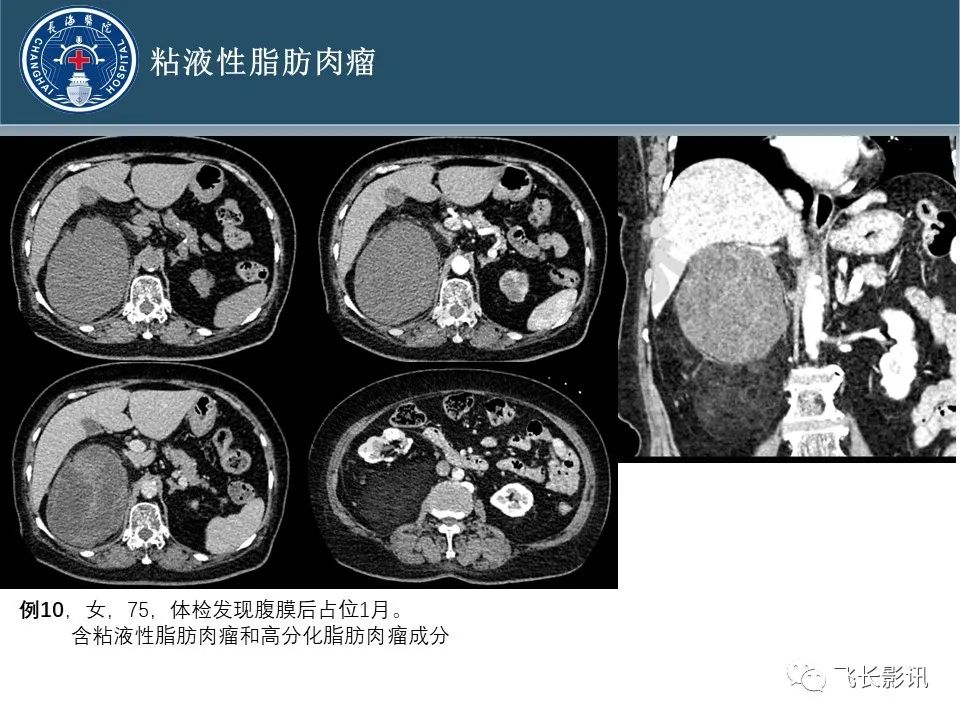 影像PPT - 【病例】腹膜后去分化脂肪肉瘤 VS 高分化脂肪肉瘤-34
