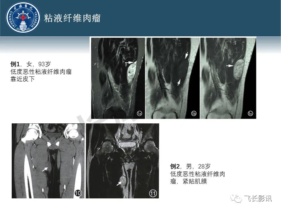 影像PPT - 【病例】腹膜后去分化脂肪肉瘤 VS 高分化脂肪肉瘤-37
