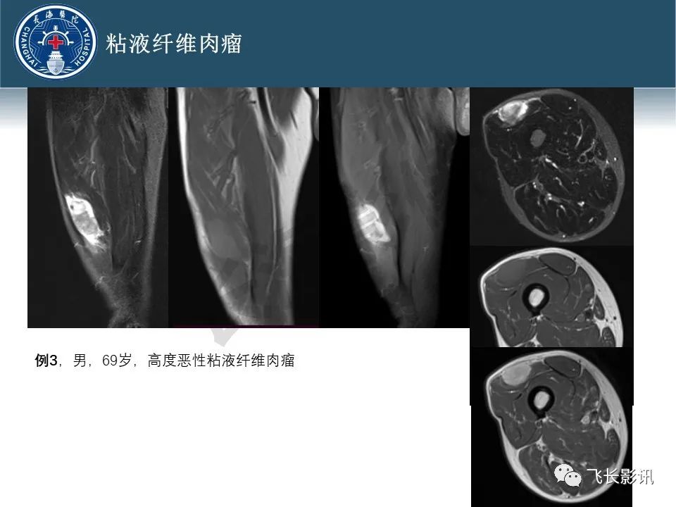 影像PPT - 【病例】腹膜后去分化脂肪肉瘤 VS 高分化脂肪肉瘤-38