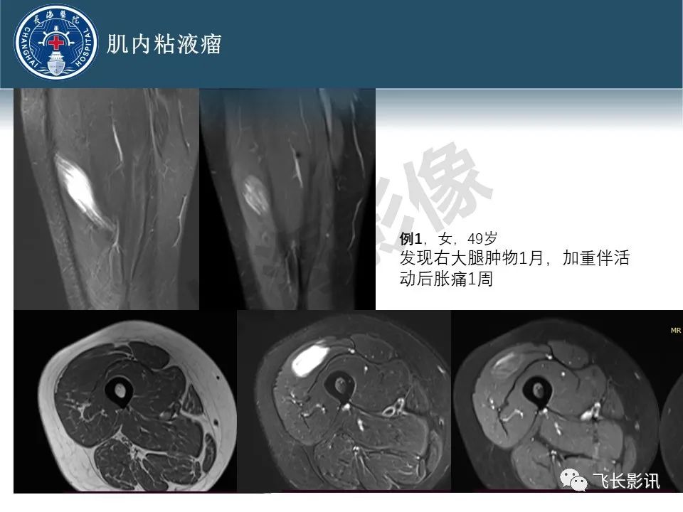 影像PPT - 【病例】腹膜后去分化脂肪肉瘤 VS 高分化脂肪肉瘤-39