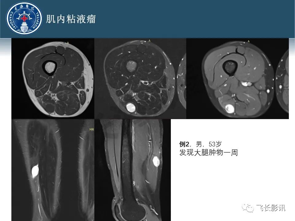 影像PPT - 【病例】腹膜后去分化脂肪肉瘤 VS 高分化脂肪肉瘤-40