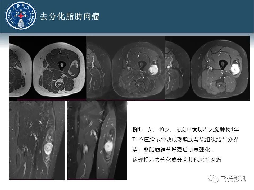 影像PPT - 【病例】腹膜后去分化脂肪肉瘤 VS 高分化脂肪肉瘤-43