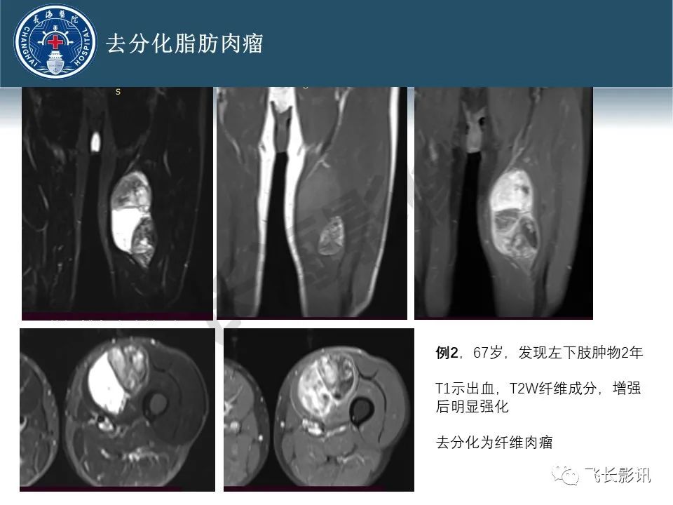 影像PPT - 【病例】腹膜后去分化脂肪肉瘤 VS 高分化脂肪肉瘤-44