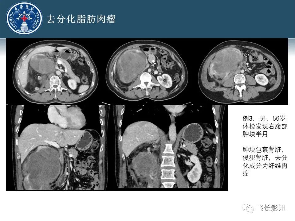 影像PPT - 【病例】腹膜后去分化脂肪肉瘤 VS 高分化脂肪肉瘤-45