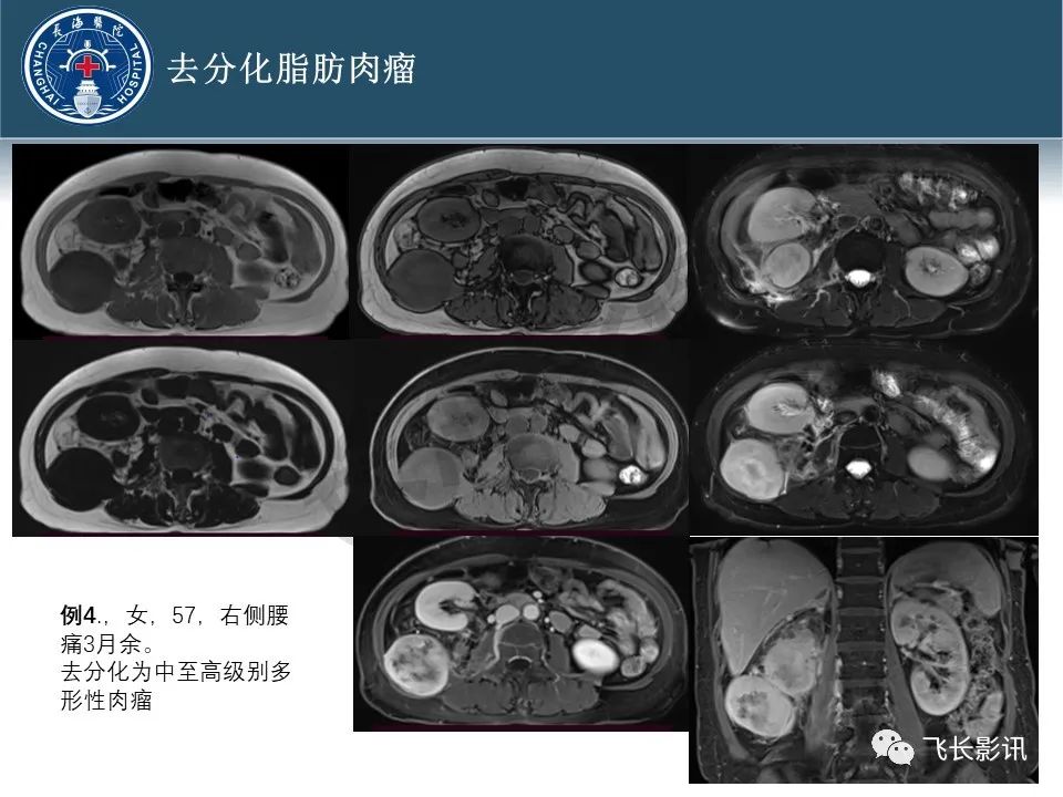 影像PPT - 【病例】腹膜后去分化脂肪肉瘤 VS 高分化脂肪肉瘤-46
