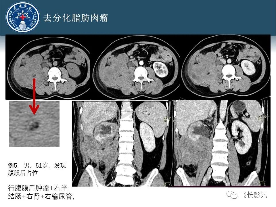 影像PPT - 【病例】腹膜后去分化脂肪肉瘤 VS 高分化脂肪肉瘤-47