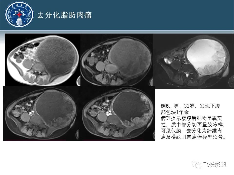 影像PPT - 【病例】腹膜后去分化脂肪肉瘤 VS 高分化脂肪肉瘤-48