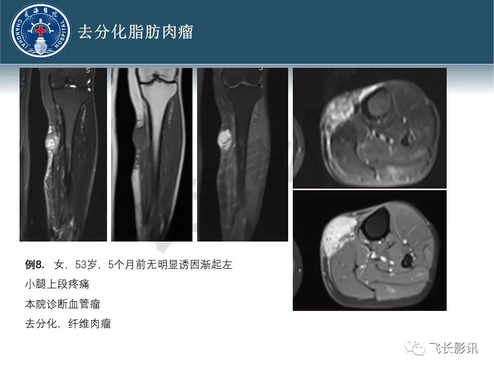 影像PPT - 【病例】腹膜后去分化脂肪肉瘤 VS 高分化脂肪肉瘤-50