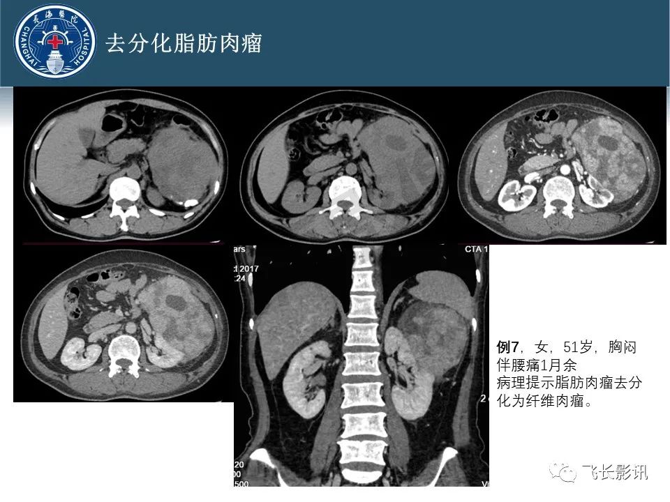 影像PPT - 【病例】腹膜后去分化脂肪肉瘤 VS 高分化脂肪肉瘤-49