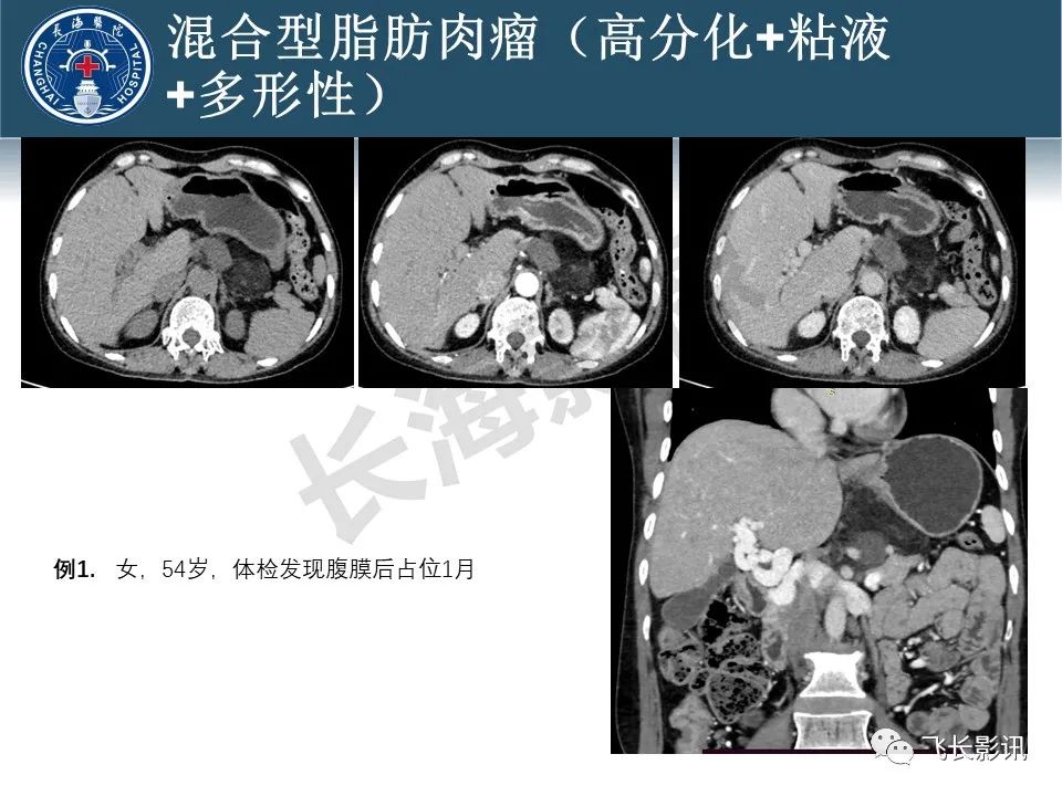 影像PPT - 【病例】腹膜后去分化脂肪肉瘤 VS 高分化脂肪肉瘤-54