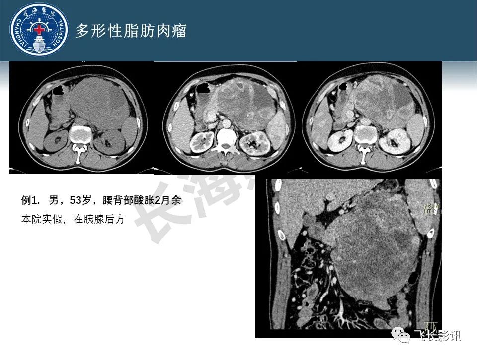 影像PPT - 【病例】腹膜后去分化脂肪肉瘤 VS 高分化脂肪肉瘤-53