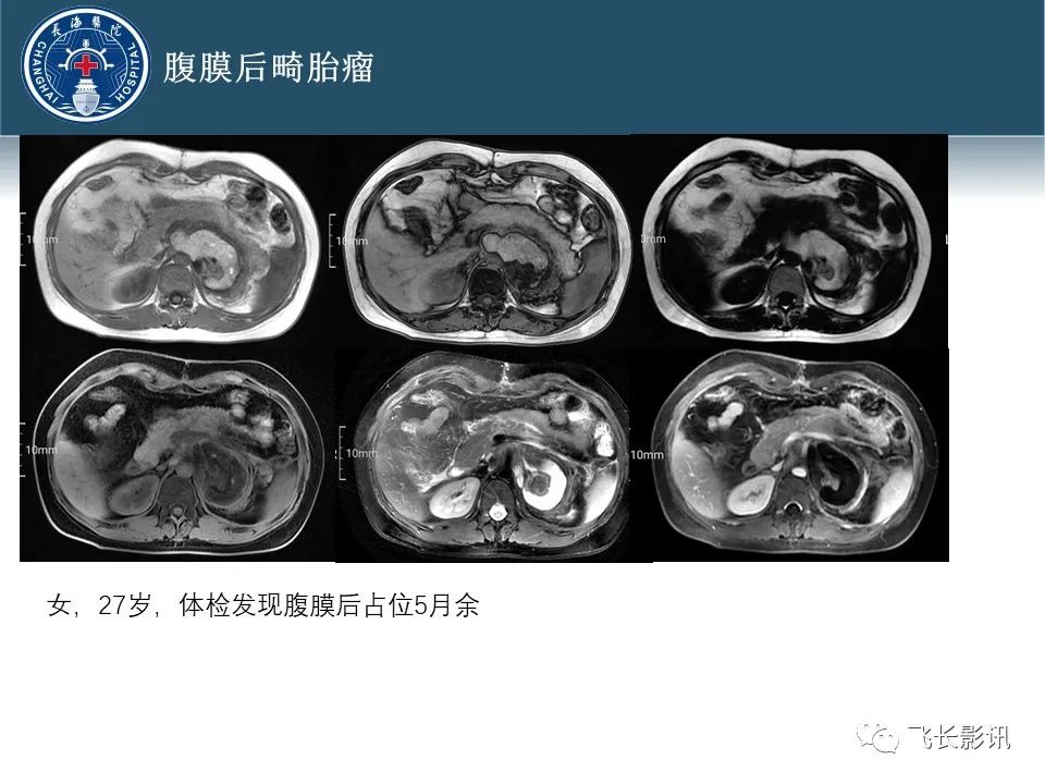 影像PPT - 【病例】腹膜后去分化脂肪肉瘤 VS 高分化脂肪肉瘤-57