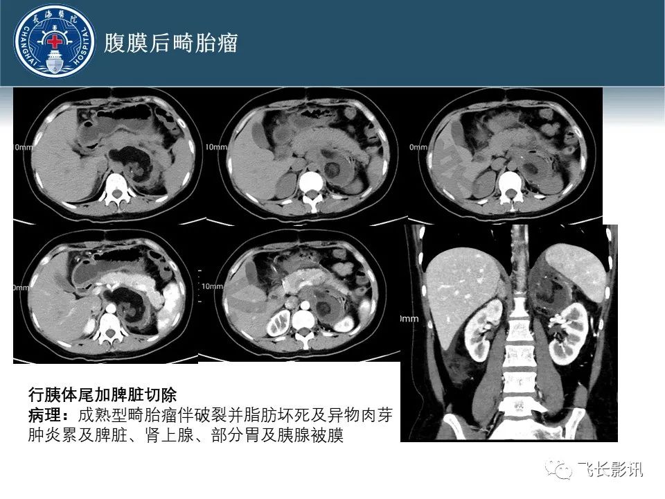 影像PPT - 【病例】腹膜后去分化脂肪肉瘤 VS 高分化脂肪肉瘤-58