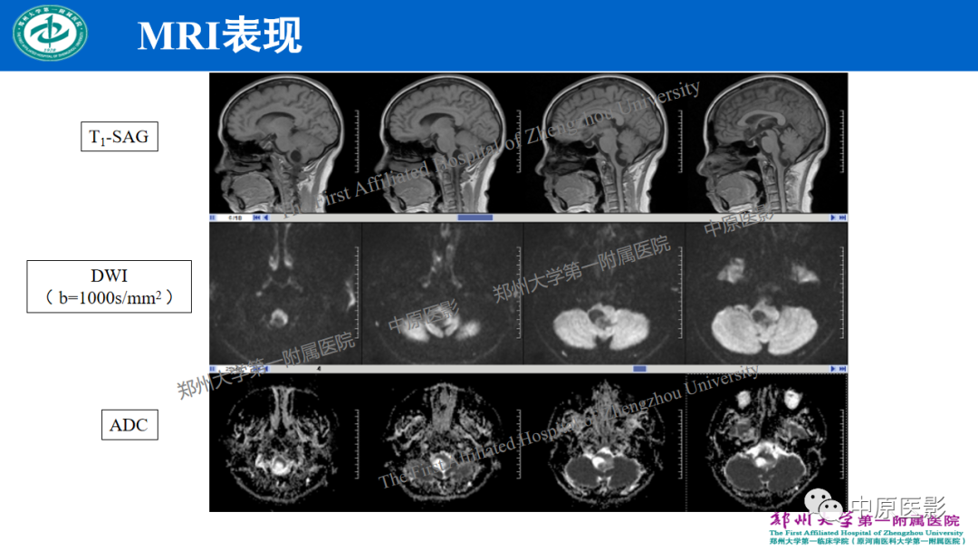 影像PPT - 【病例】枕骨大孔区脉络丛乳头状瘤1例MR影像-4