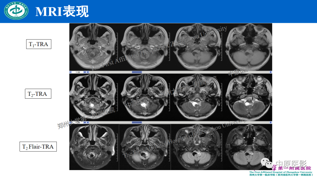 影像PPT - 【病例】枕骨大孔区脉络丛乳头状瘤1例MR影像-3